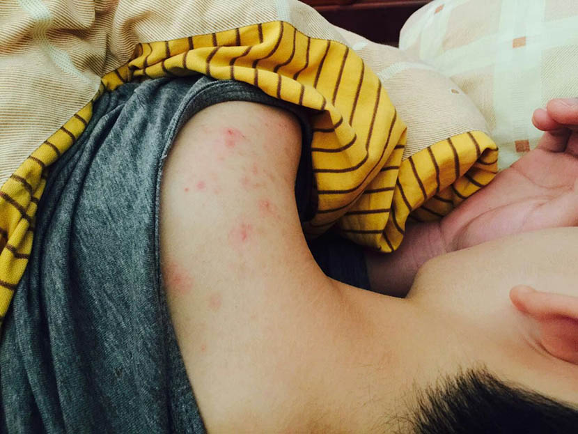 A rash on a student’s shoulder, Changzhou, Jiangsu province, Jan. 2016. Courtesy of the student’s parents.
