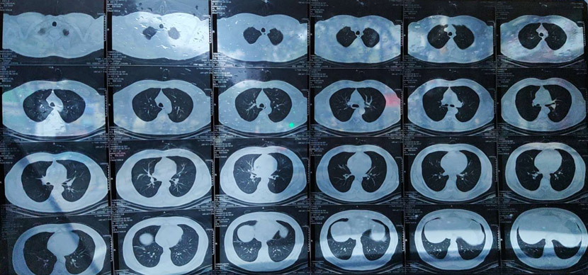 A CT scan showing the viral infection in Zhang Chi’s lungs. Courtesy of Zhang Chi