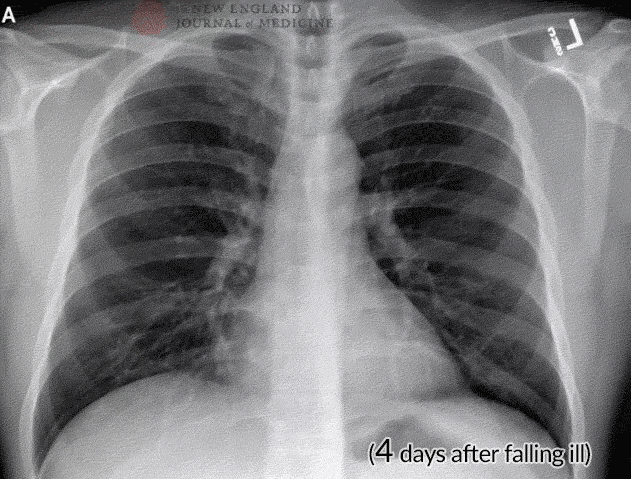 A GIF shows the coronavirus patient’s posteroanterior chest radiographs on the 4th, 7th , 9th, and 10th days of illness. From NEJM医学前沿 on WeChat