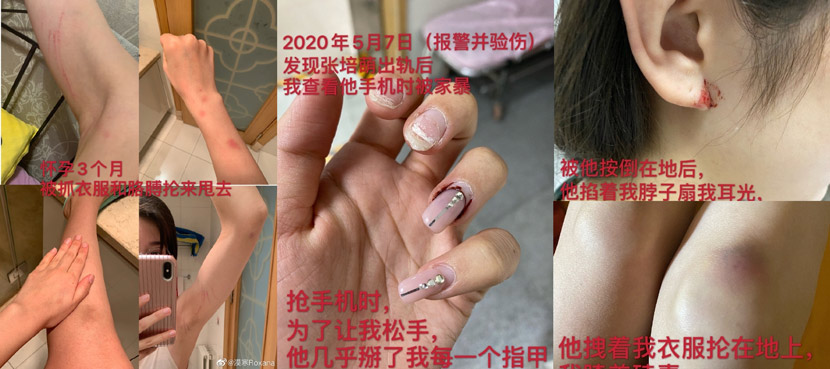 Photos shared Zhang Mohan shared online as evidence of her husband’s abuse. From @漠寒Roxana on Weibo