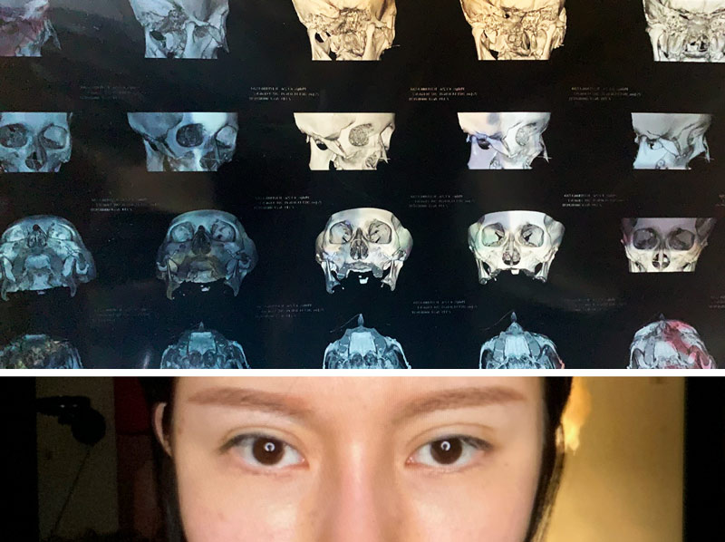 Top: A CT scan of Gao’s face, which indicated the tissue in her nose was swelling, performed in January 2021; Bottom: A selfie of Gao, showing her swollen nose. Courtesy of Gao