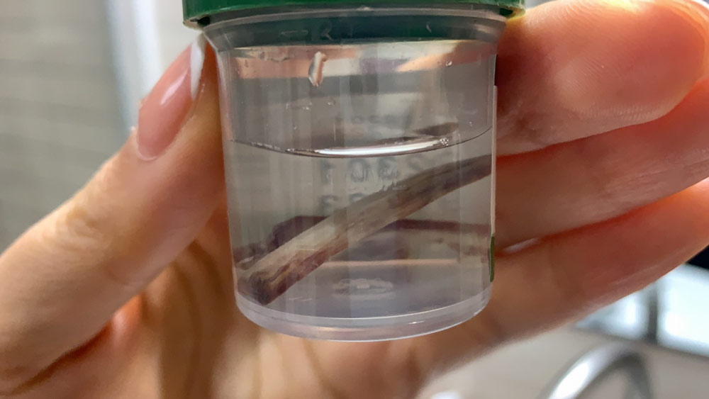 The pieces of cartilage from Gao’s nose, stored in a jar full of formaldehyde, June 25, 2021. Gao hopes to use the cartilage as evidence in her lawsuit against the clinic that performed the nose job. Coutersey of Gao