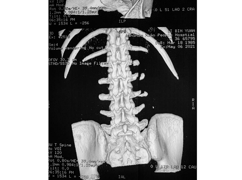 An X-ray shows broken bones in Li’s back. Courtesy of Li Binyuan