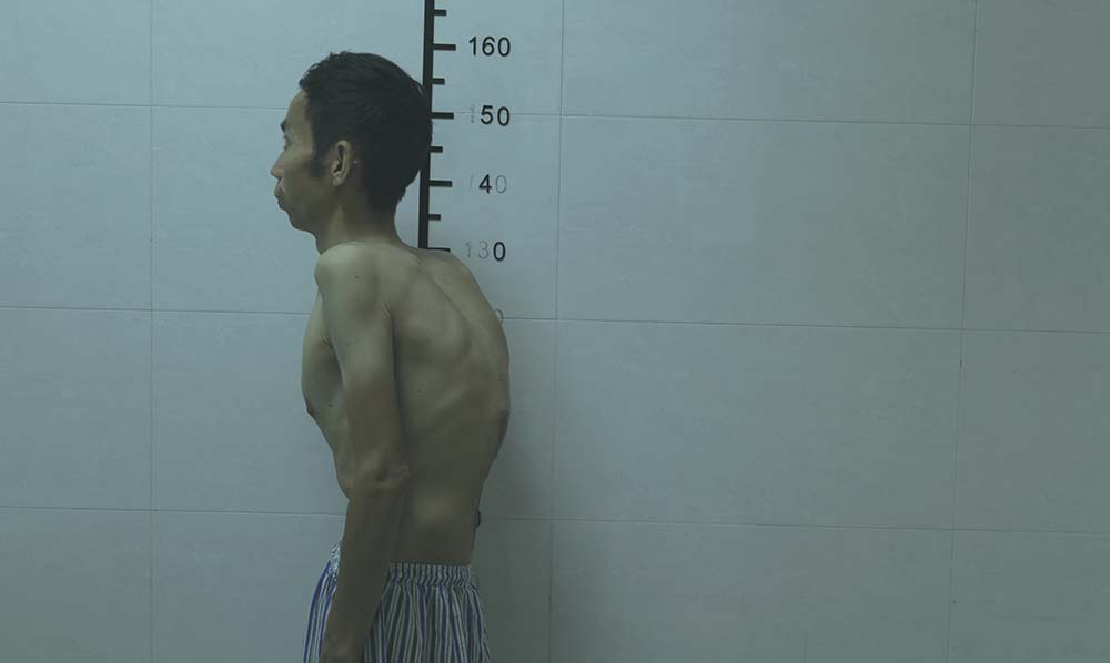 Zhang Tiancai, an ankylosing spondylitis patient, stands at 1.6 meters tall after his first spinal operation, Beijing, 2021. Zhao Zixuan and Lü Qianyuan for Sixth Tone