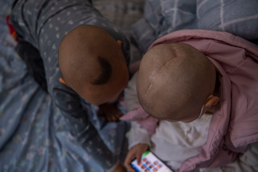 A young patient (left) plays with a mobile phone after a craniotomy for NF, Hunan province, 2020. IC