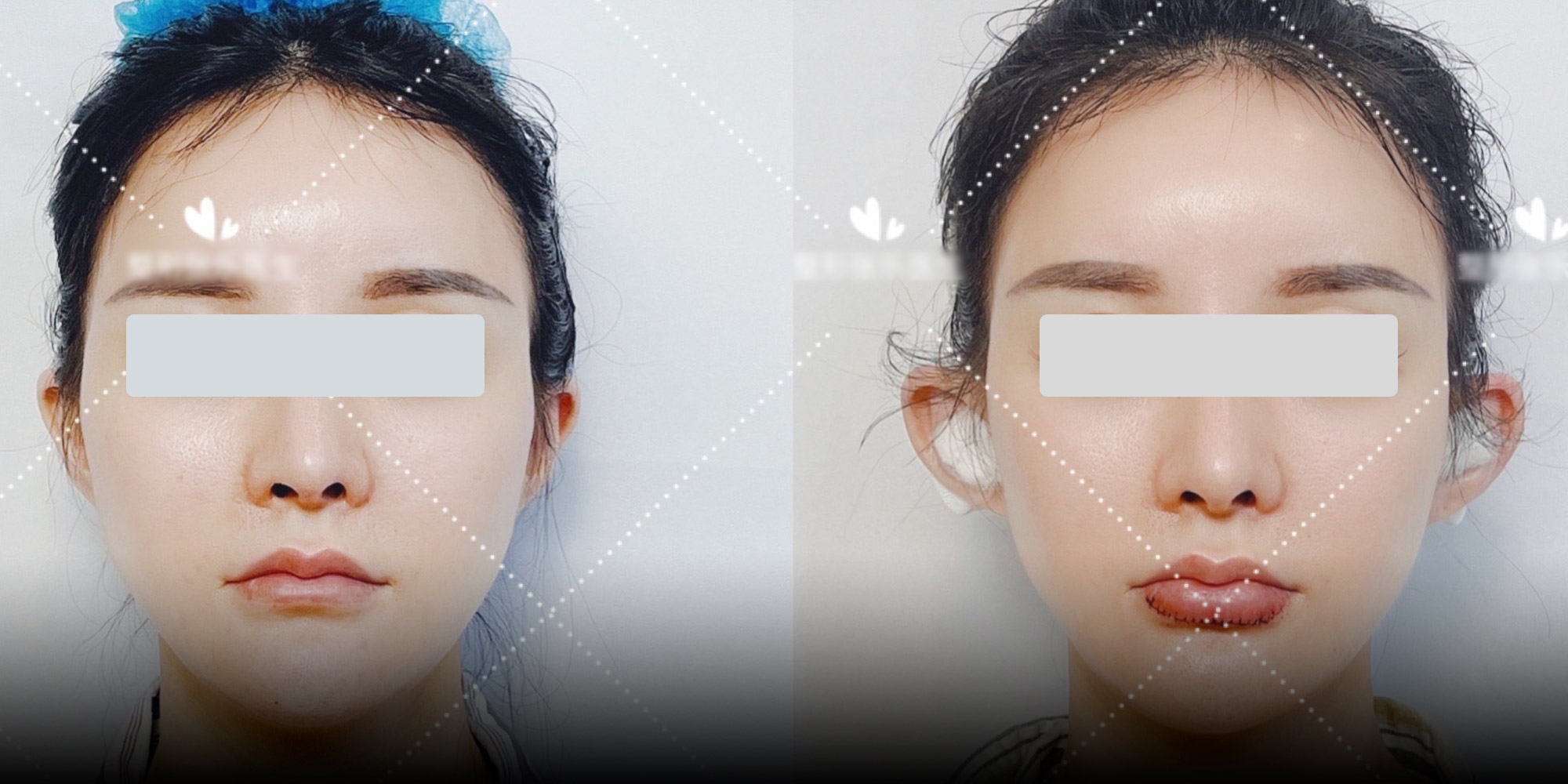 Do Facial Slimming Exercises Work? Facial Plastic Surgeon's Perspective