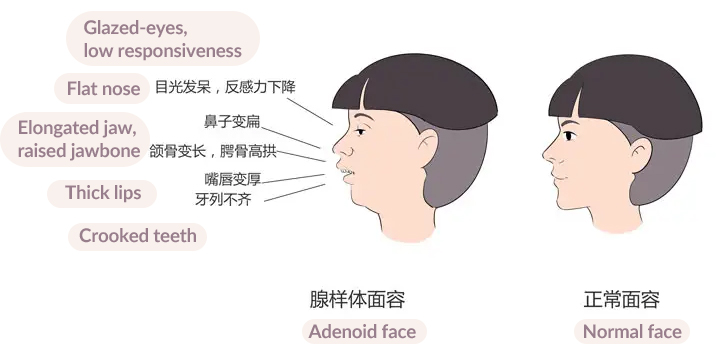 A diagram shows the symptoms of adenoid face. Courtesy of United Family Healthcare, translated by Sixth Tone