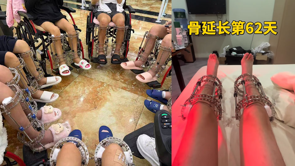 Investigation Uncovers China’s Underground Height Surgery Market